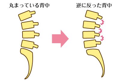 ぎっくり腰イメージ